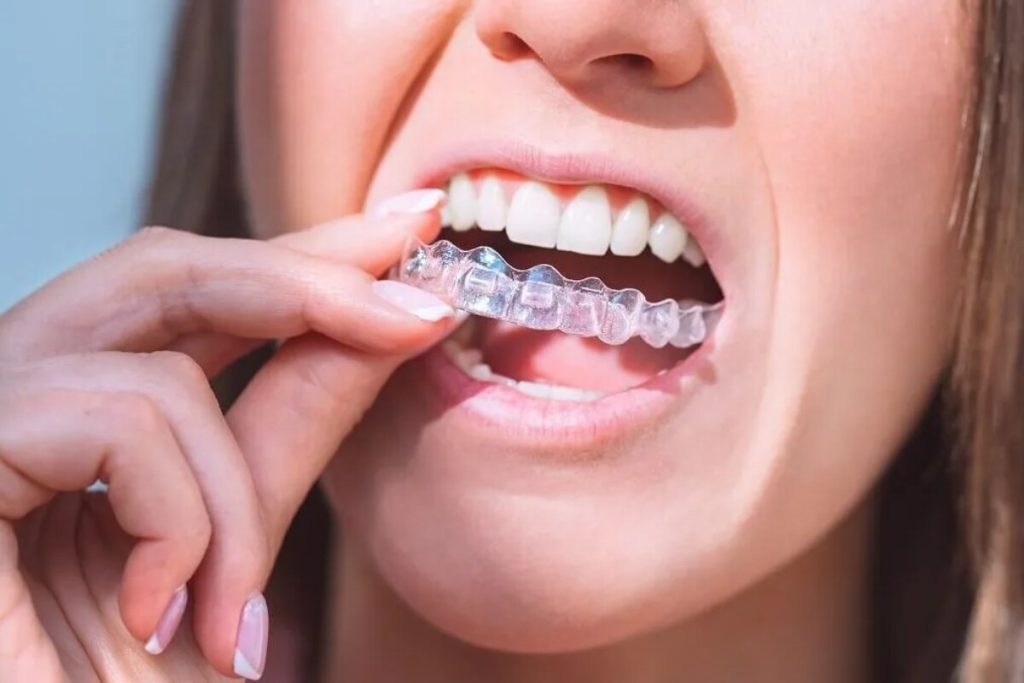 what dentists check before recommending clear aligners